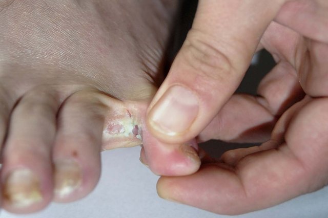 Peeling skin between the toes
